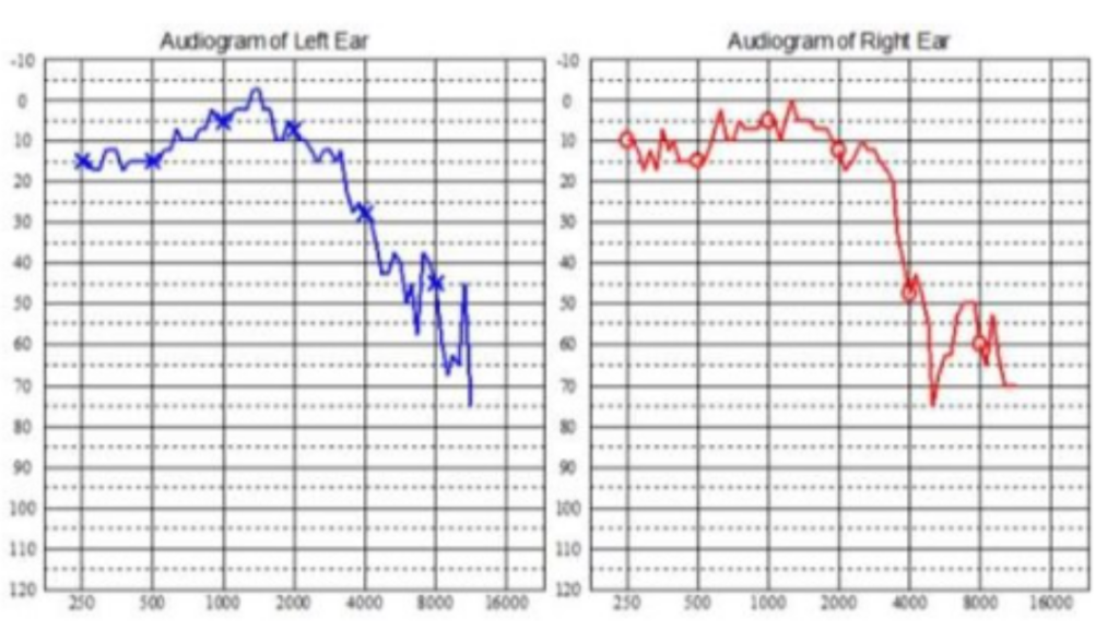 microaudiometria