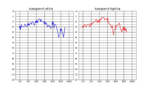 microaudiometria ama-pta audiograma